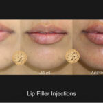 Lip Aug4A Nazarian Plastic Surgery