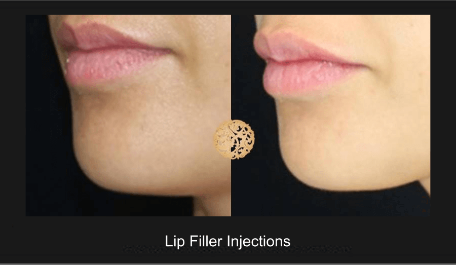 Lip Augmentation Gallery