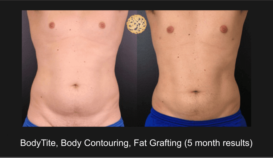 Male patient's BodyTite, body contouring, and fat grafting results after 5 months, showing a more defined abdomen