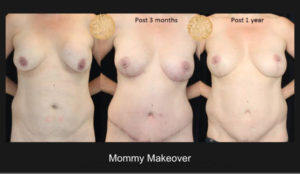 Mommy Makeover 119 1 Nazarian Plastic Surgery