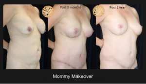 Mommy Makeover 119 3 Nazarian Plastic Surgery
