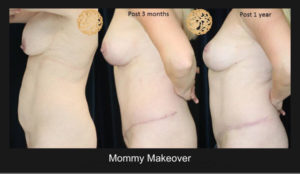 Mommy Makeover 119 4 Nazarian Plastic Surgery