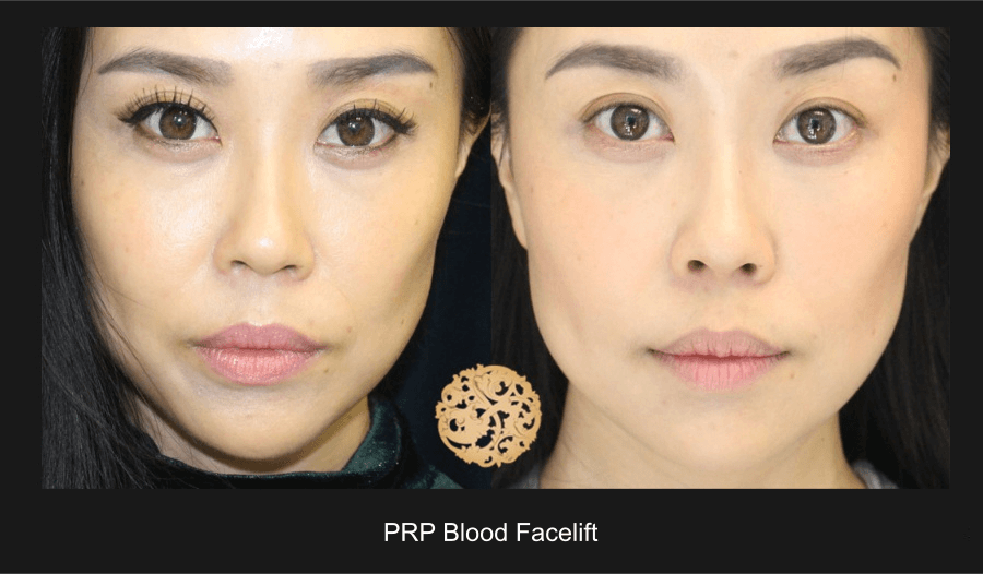 PRP Blood Facial Gallery