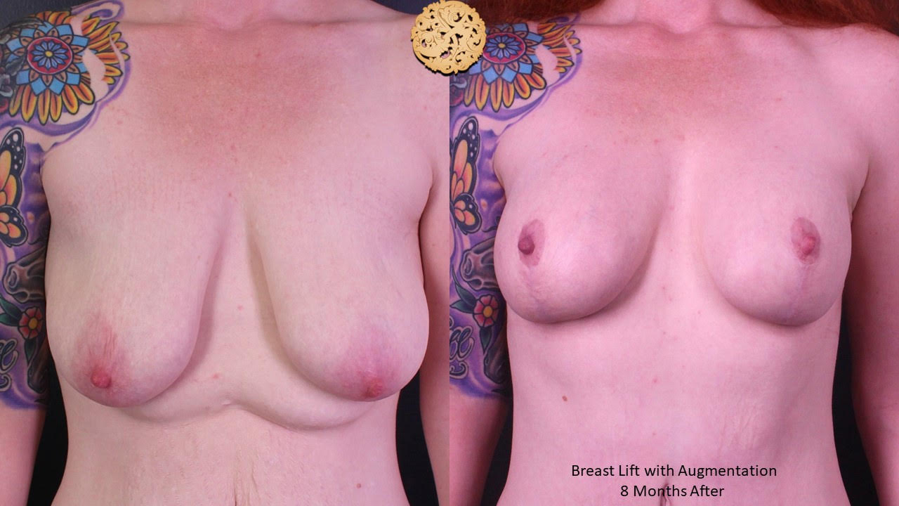 Breast Lift Gallery