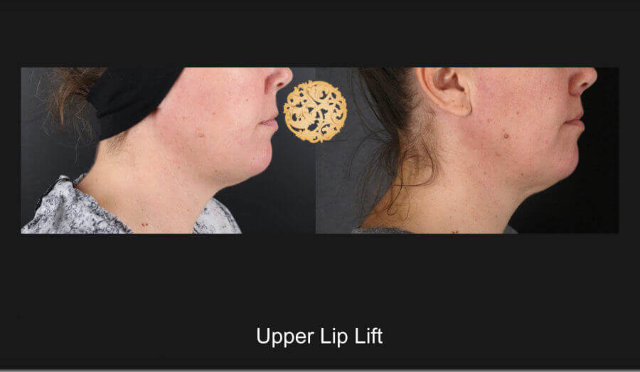 upper-lip-lift-e