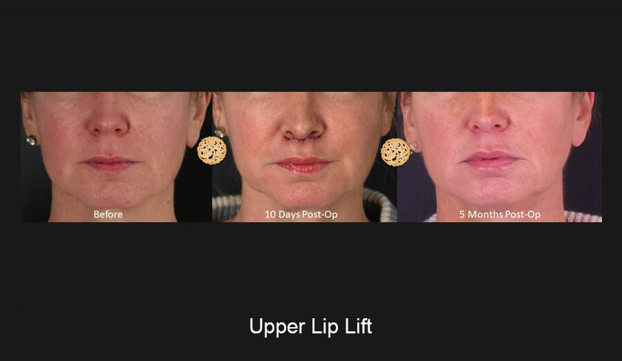 upper-lip-slide1