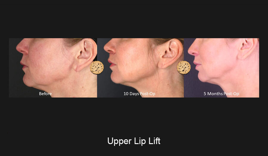 upper-lip-slide3