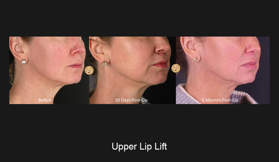 upper-lip-slide5