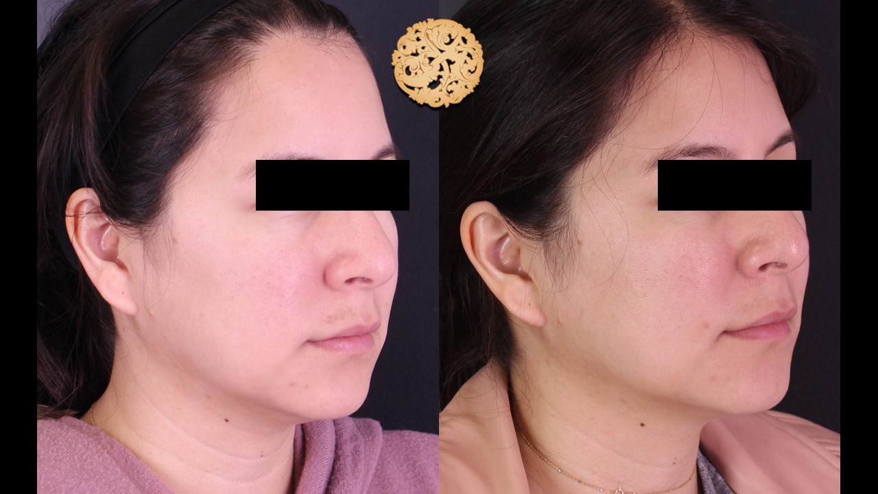 Tear Trough Injection – Before and After Gallery