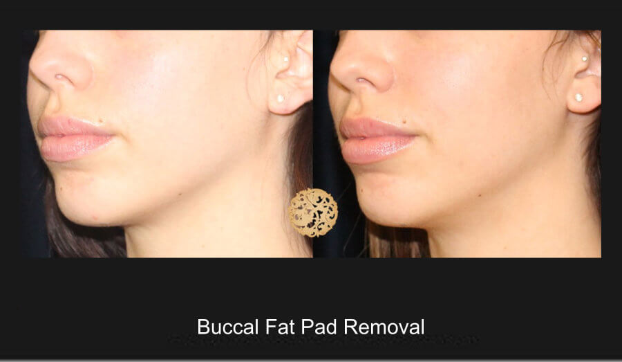 Buccal Fat A Nazarian Plastic Surgery