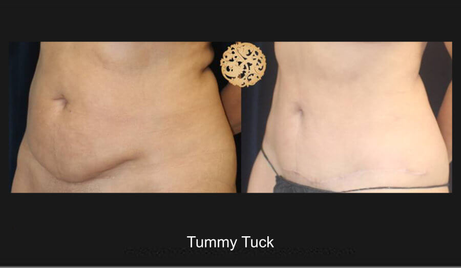 tummy-tuck-4.jpg