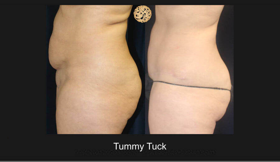 tummy-tuck-5