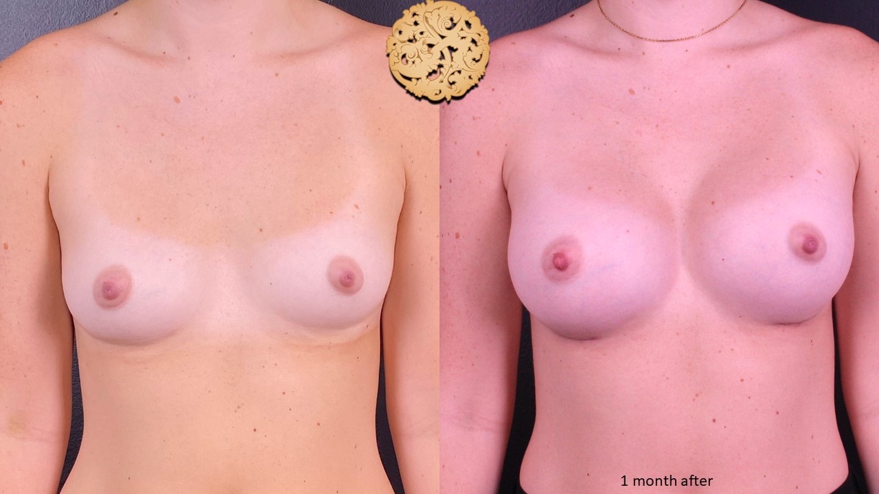 breast augmenation