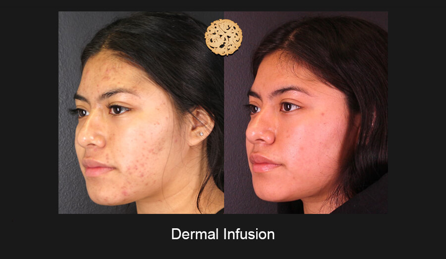 Dermal Infusion Gallery
