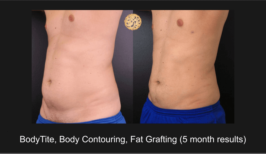 Male Fat Grafting / Fat Transfer – Before and After
