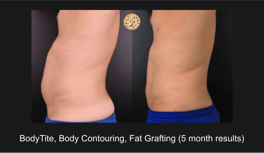 Male Body Contouring and Liposuction Gallery