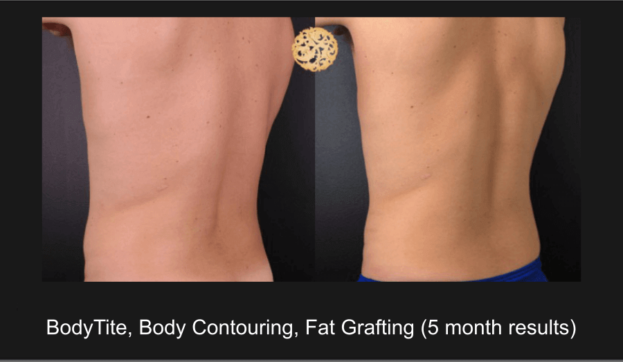 Male Fat Grafting / Fat Transfer – Before and After