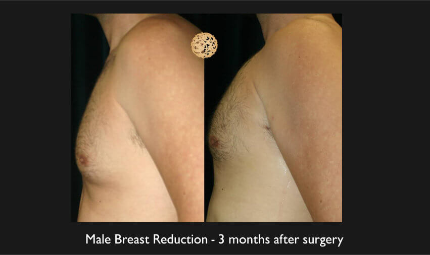 Male Breast Procedures Gallery