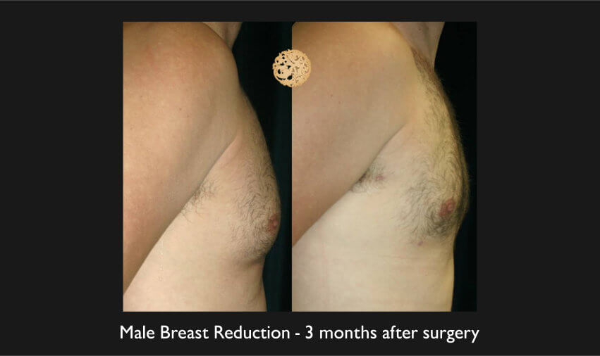 Male Breast Procedures Gallery