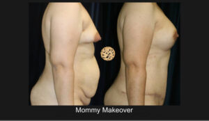 Mommy Makover 3B Nazarian Plastic Surgery