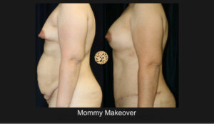 Mommy Makover 3D Nazarian Plastic Surgery