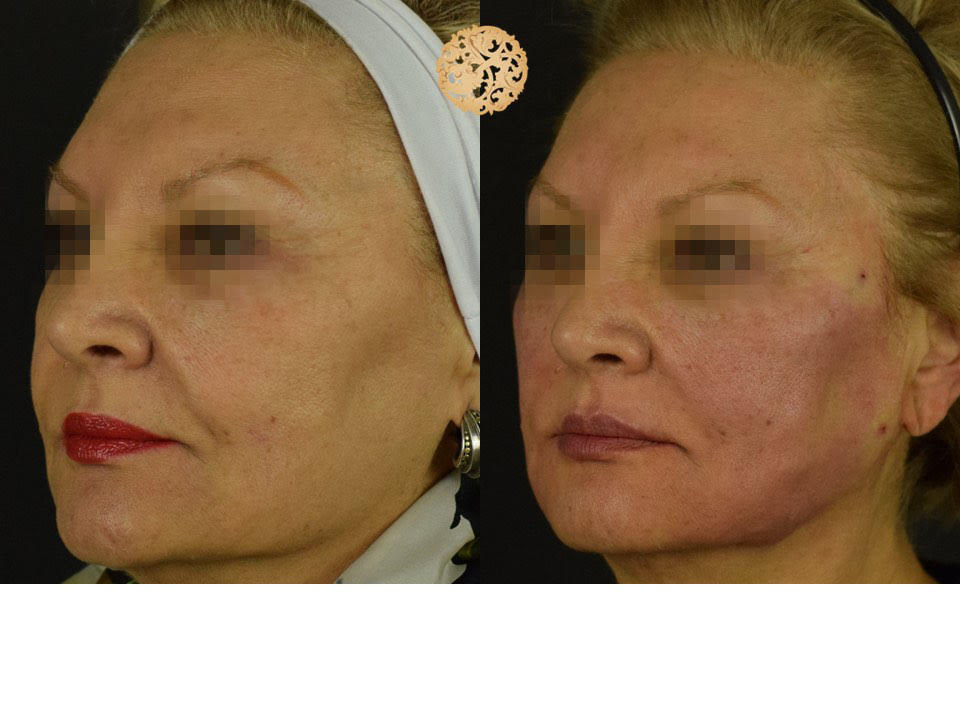 Facial Thread Lifting Before and After Gallery