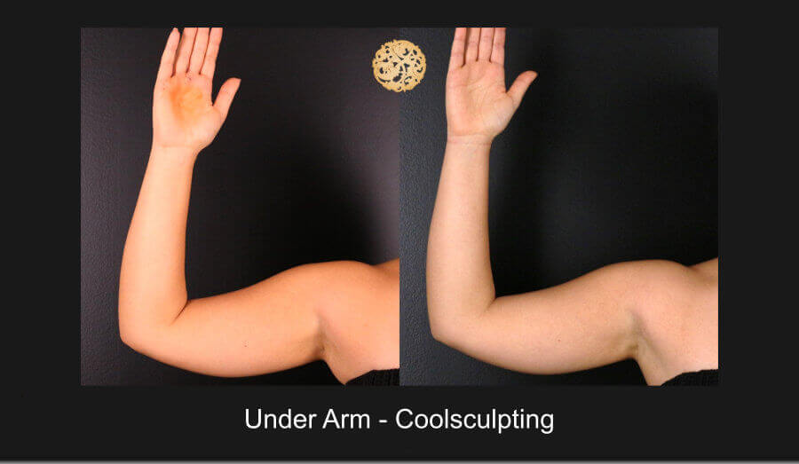 Coolsculpting Arms 1318 G Nazarian Plastic Surgery