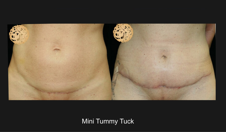 Mini Tummy Tuck Before And After Photo Gallery