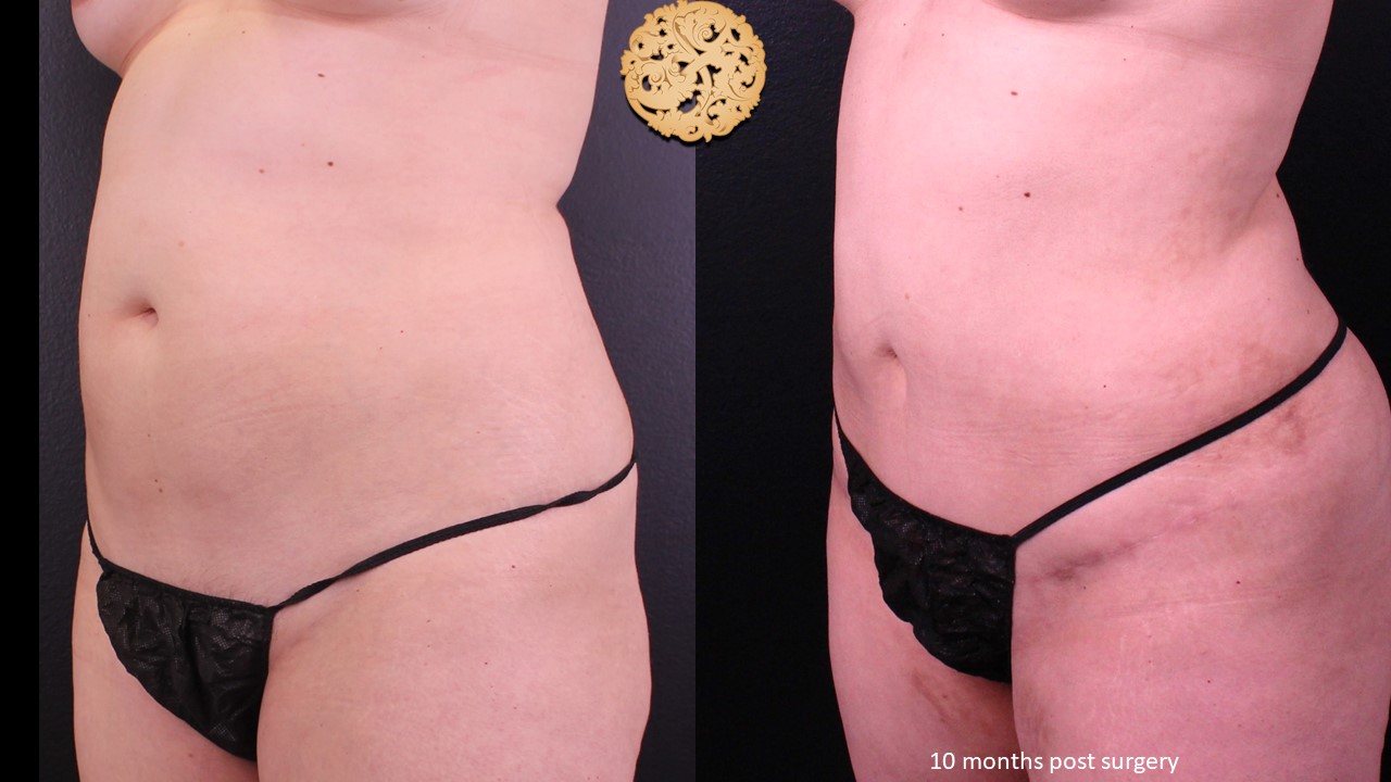 Mini Tummy Tuck Before And After Photo Gallery