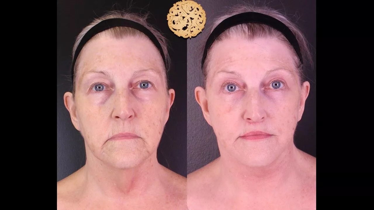 V-Lyft Face and Neck Lift before and after