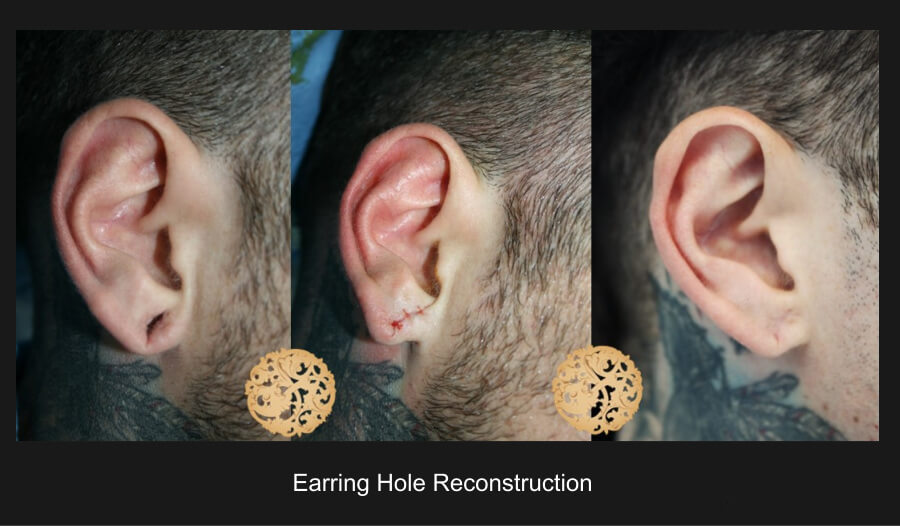 Earring Hole Recontruction Gallery