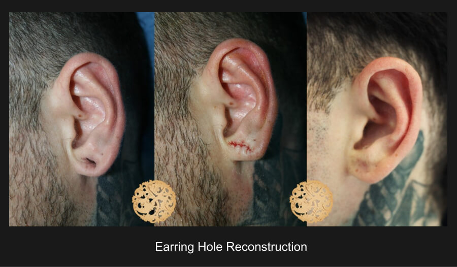 Earring Hole Recontruction Gallery