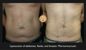 Male Tummy Tuck / Liposuction