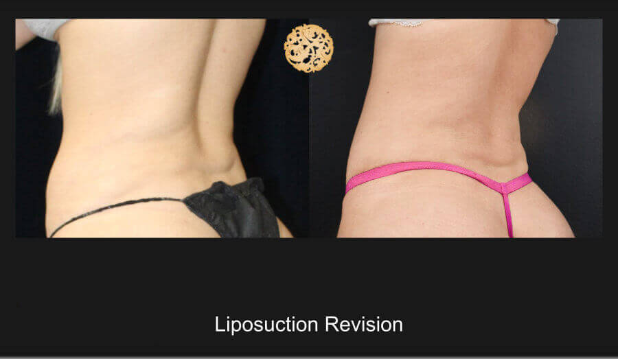 Liposuction Revision – Before and After