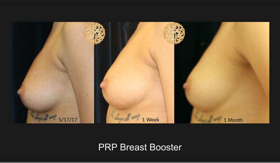 PRP Breast Booster