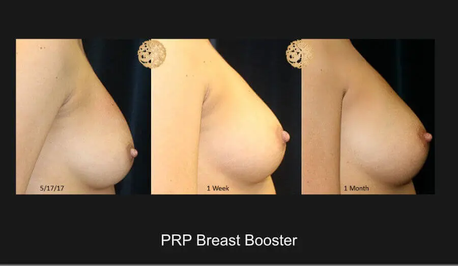 PRP Breast Booster