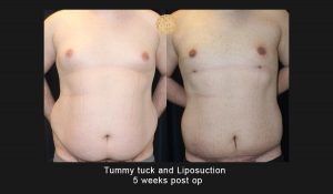 Male Tummy Tuck / Lipo