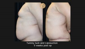 Male Tummy Tuck / Lipo