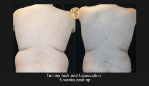 Male Body Contouring and Liposuction Gallery