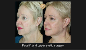 Side profile comparison of a patient before and after undergoing facelift and upper eyelid surgery, illustrating the significant anti-aging effects achieved by a Beverly Hills plastic surgeon.