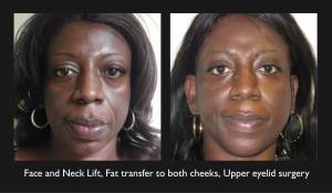 Before And After Photos Showcasing The Transformation Achieved With A Face And Neck Lift, Fat Transfer To Cheeks, And Upper Eyelid Surgery By A Renowned Beverly Hills Cosmetic Surgeon.