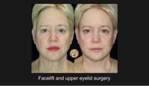 Before and after images showing the transformative results of facelift and upper eyelid surgery, revealing a more youthful and refreshed appearance.