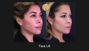 Elegant Facial Contouring Through Expert Face Lift Procedure, Displaying Before And After Comparison, Exemplifying Refined Aesthetic Results Achieved At A Beverly Hills Clinic