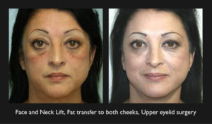 Comprehensive Facial Rejuvenation Showcasing Face And Neck Lift With Fat Transfer To Cheeks And Upper Eyelid Surgery, Highlighting Transformative Results In Beverly Hills Clinic.