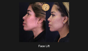 Before-And-After Visuals Showcasing The Remarkable Results Of A Face Lift Surgery, Highlighting The Defined Jawline And Improved Profile Achieved By A Beverly Hills Specialist.