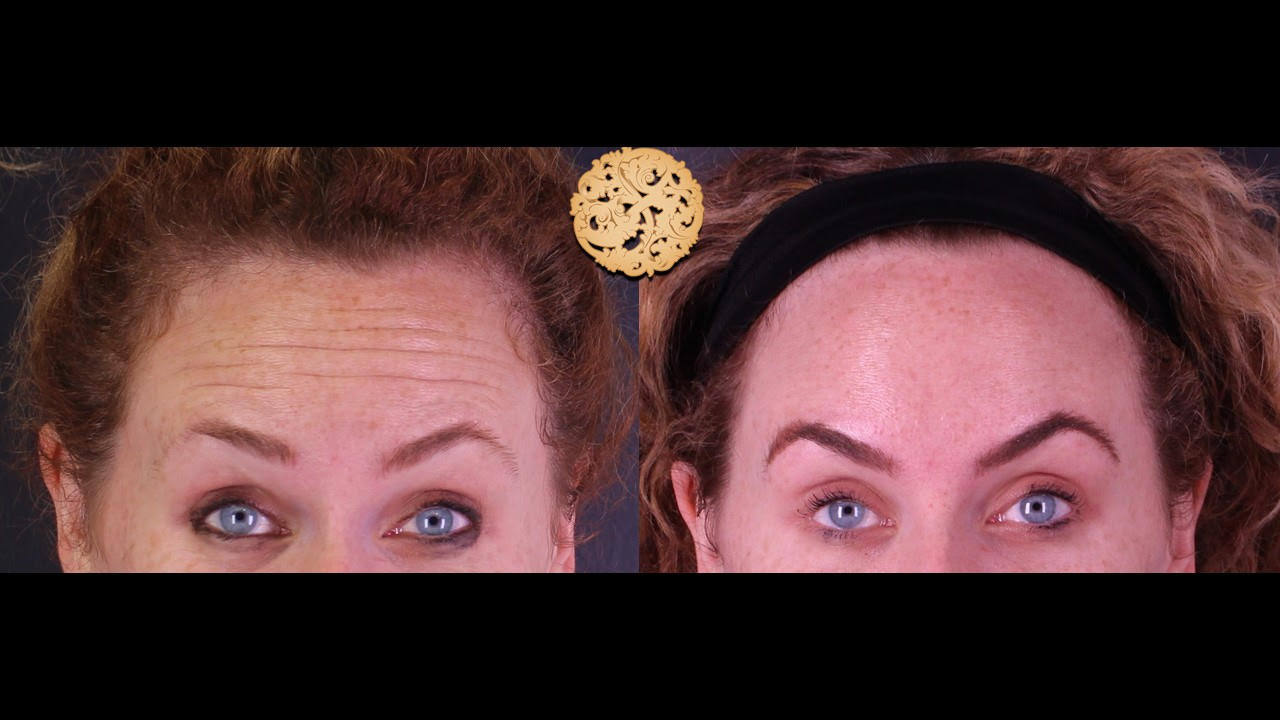 Gold Tip Botox Facial