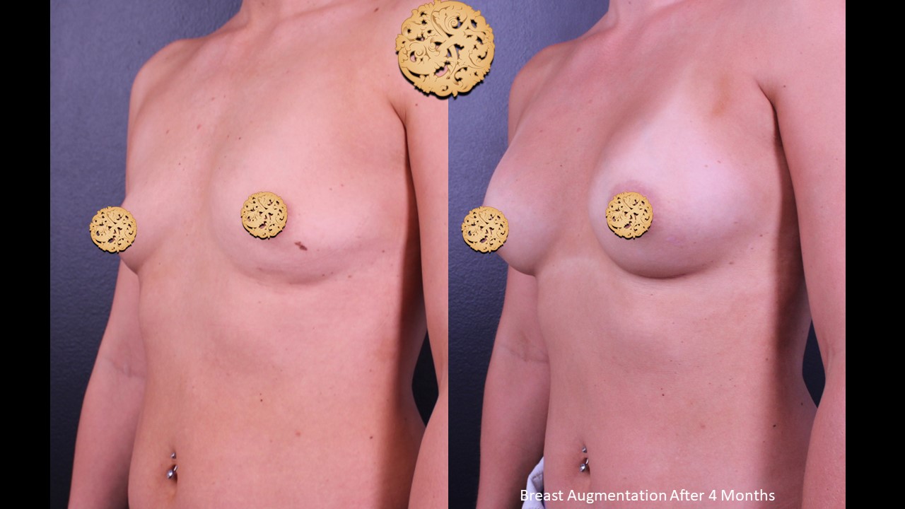 Comparative Results 4 Months Post Breast Augmentation Surgery Showing Enhanced Volume And Contour