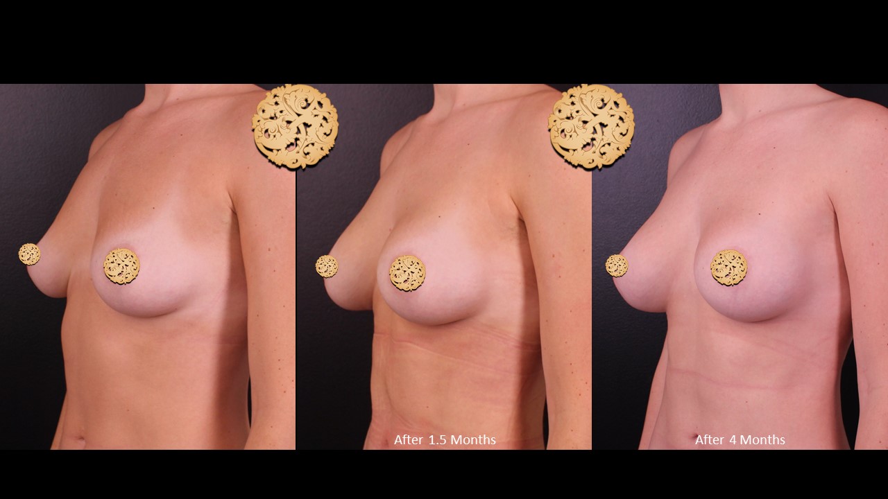 Evolution Of Breast Augmentation Treatment Over 1.5 To 4 Months Showing Significant Volume Increase And Improved Shape
