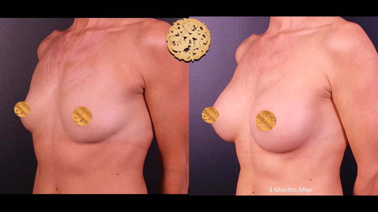 Results Of Breast Implant Augmentation Procedure For Increased Volume, 3 Months Post-Operation