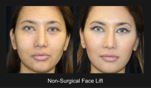 Non Surgical Face Lift 2 Nazarian Plastic Surgery